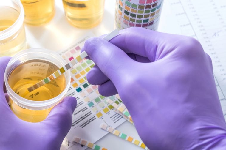 Urine test for potassium levels Urine test for potassium levels