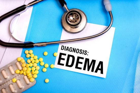 Edema Edema